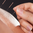 acupuntura